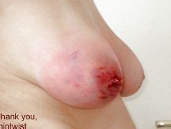 Tortured Tits Whipped Wife Beaten And Bruised Faked Pics Porn