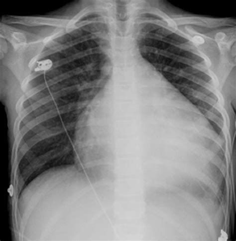 Image: Dilated Cardiomyopathy (Chest X-Ray) - MSD Manual Professional Edition