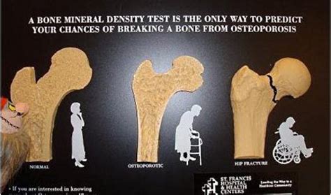 Osteoporosis and Bone Density Screening | Facts on About Osteoporosis