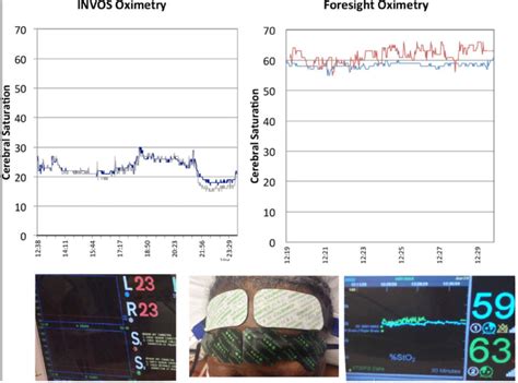 Relative Vs Absolute Cerebral Oximetry Does A Skin Pigmentation