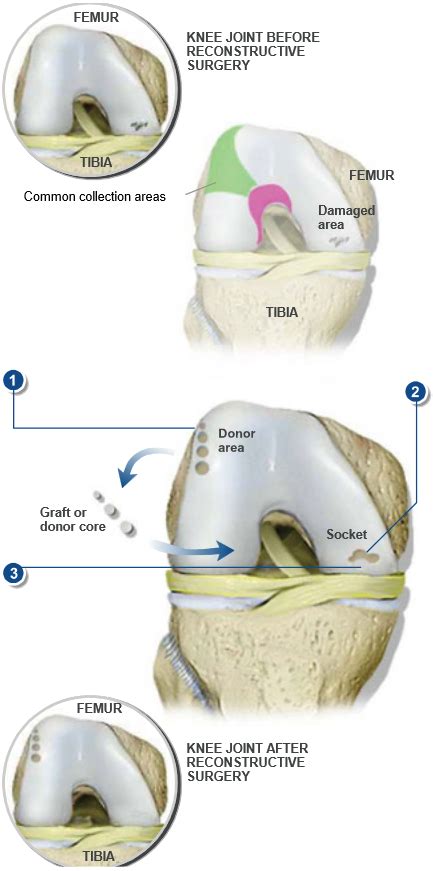 Oats Cartilage Repair Surgery Central Coast Orthopedic Medical Group