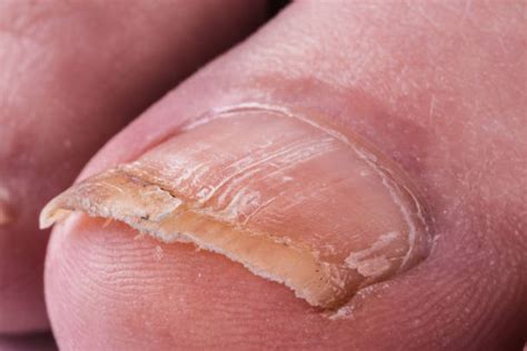 Psoriasis In Toenails Stock Photos, Pictures & Royalty-Free Images - iStock