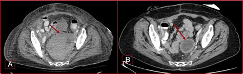 Diversion Ahead Imaging Appearance Of Urinary Diversions And