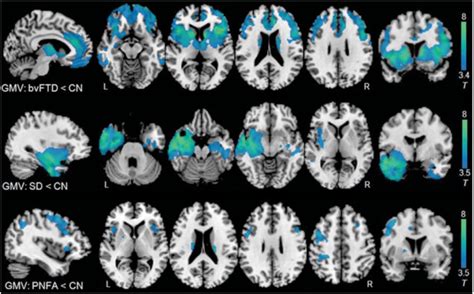 Comparison Of Gray Matter Atrophy Patterns In Three Ftd Syndromes