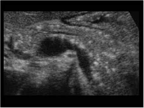 Wk 6 Panc Pathology Chronic Pancreatitis Ultrasound Sonography