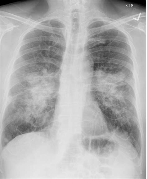 Pulmonary Roundtable Sarcoid Treat