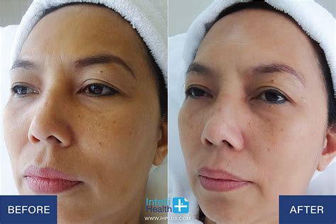 Facial Rejuvenation Intellihealth Plus Rejuvenation Clinic