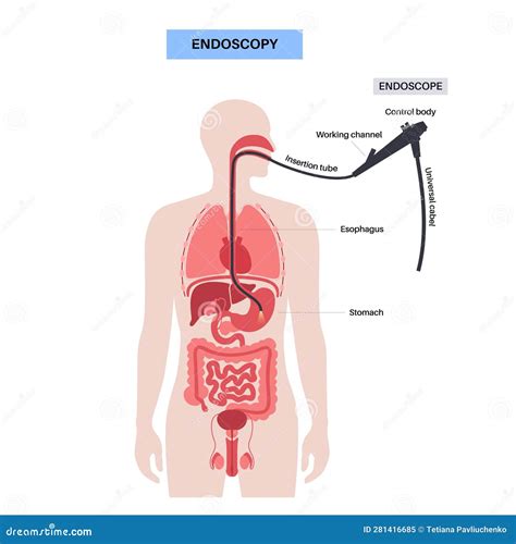 Gastroscopy Endoscopy Procedure Stock Vector - Illustration of gastric ...