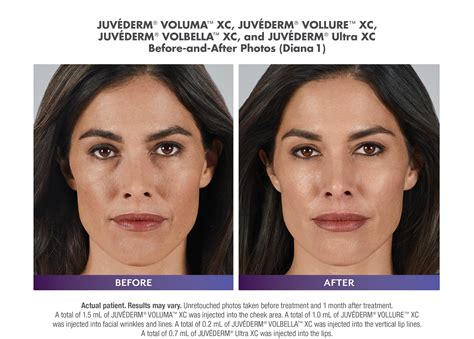 Unveiling The Benefits Of Dermal Fillers Enhance Your Natural Beauty