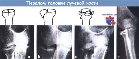 Признаки перелома головки лучевой кости и его современное лечение