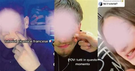 «cicatrice Francese Tiktok Nel Mirino Parla Balzano «È La Risposta A