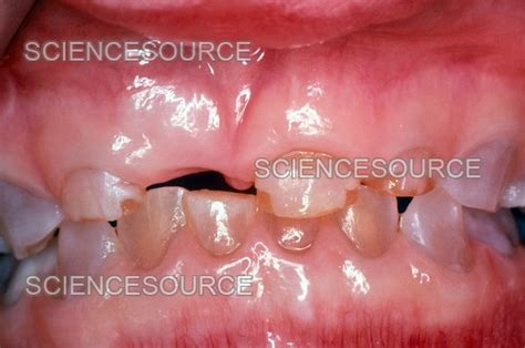 Dentinogenesis Imperfecta Stock Image Science Source Images