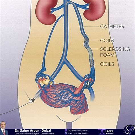 Pelvic Congestion Syndrome Treatment in Dubai - 7 Varicose Veins ...