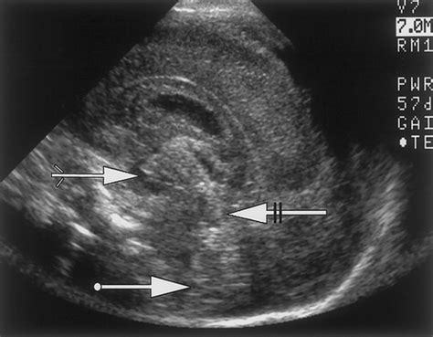 Neonatal Head Ultrasound