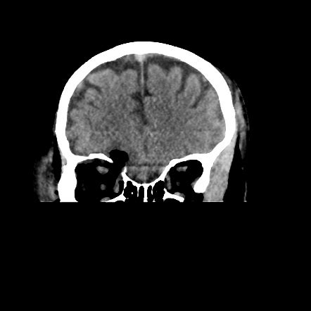 Superior orbital blowout fracture | Radiology Case | Radiopaedia.org