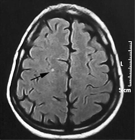 Relation Between Migraine Pattern And White Matter Hyperintensities In