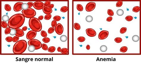 El Laboratorio En El Diagn Stico De Anemia Interhospital