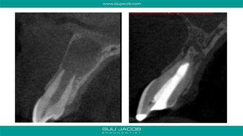 Large lesion healing: Video+slides