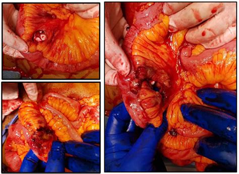 Figure 2 Showing Different Mesenteric Defect Injuries Bucket Handle