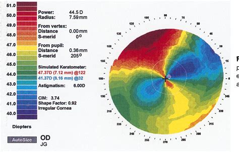 Normal Corneal Topography