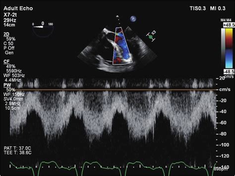 Pulsed Wave Pw Doppler Echocardiogram Demonstrating The Absence Of Download Scientific