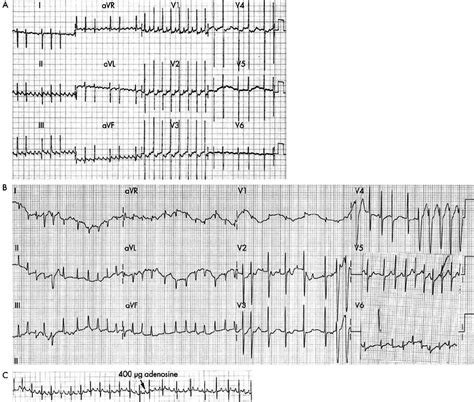 Atrial Tachycardias A 12 Lead Electrocardiogram During Atrial