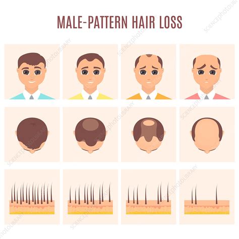 Male pattern hair loss, illustration - Stock Image - F032/1311 ...