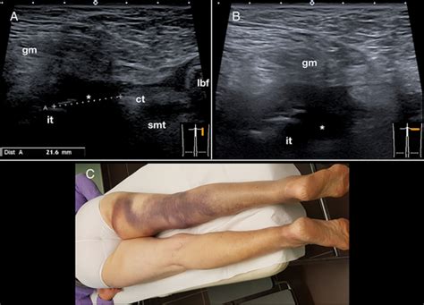 Ultrasound Features Of The Proximal Hamstring Muscle‐tendon‐bone Unit