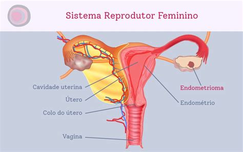 Endometrioma Veja Como Feito O Diagn Stico