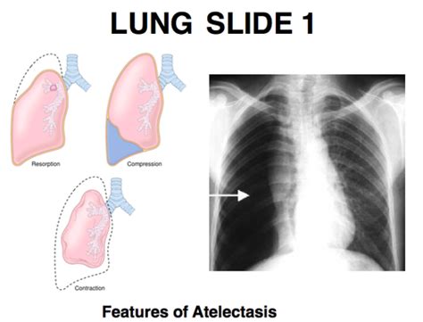 Clin Skill Chest Radiography Flashcards Quizlet