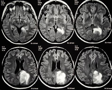 what happens in the final stages of glioblastoma - Chunky Portal Photos