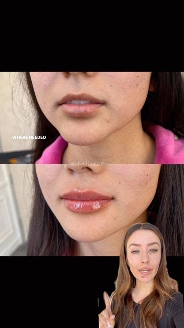 Snatched Beverly Hills On Instagram Placing Filler In The Chin And