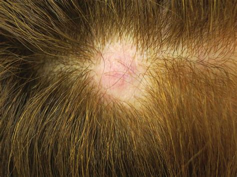 Alopecia Neoplastica Bmj Case Reports