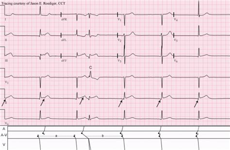 Junctional escape rhythm | ECG Guru - Instructor Resources