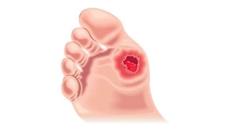 Management And Prevention Of Diabetic Foot Ulcers Woundsource