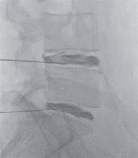 The Spinal Needle For Platelet Rich Plasma Injection Into The L4 L5 And Download Scientific