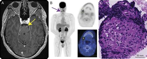 Teaching Neuroimages Recurrent Oculomotor Palsies Caused By