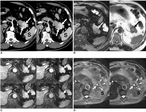 Intrapancreatic Accessory Spleen Findings On Mr Imaging Ct Us And