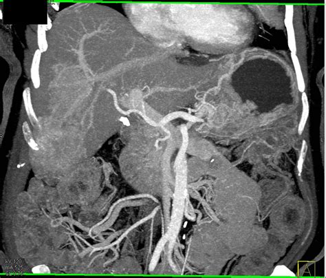 Metastatic Neuroendocrine Tumor Tail Of Pancreas With Liver Metastases