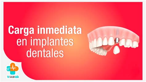 Carga Inmediata En Implantes Dentales Tu Salud Gu A Youtube