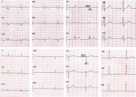 Top PreTAVI 12lead ECG Showing RBBB LAFB 1AV Block Bottom