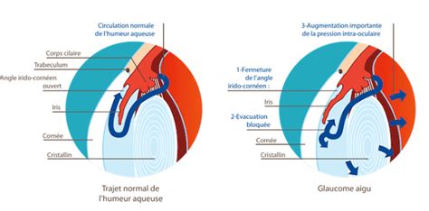 Pdf Glaucome Aigu Par Fermeture De L Angle Symptomes Pdf T L Charger