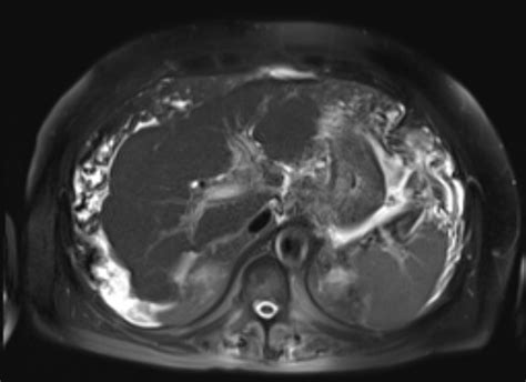 Acute Portal Vein Thrombosis Image