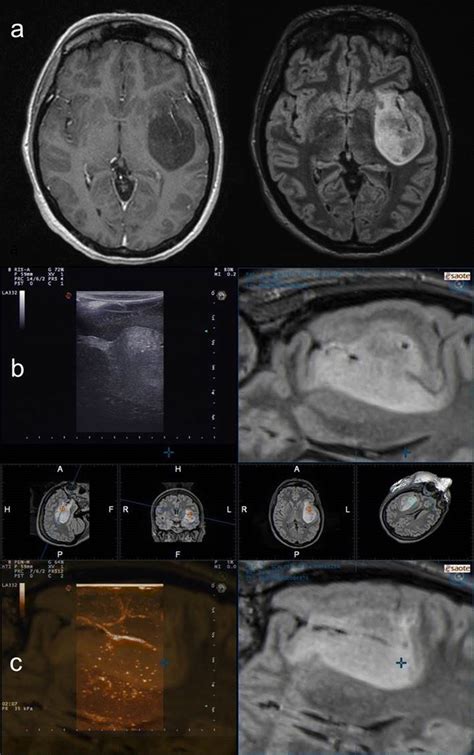 A Contrast Enhanced T And Flair Weighted Axial Mri Scans Showing A