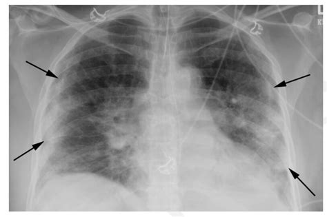 COVID-19: Making Intelligent use of HRCT Thorax as a diagnostic tool ...