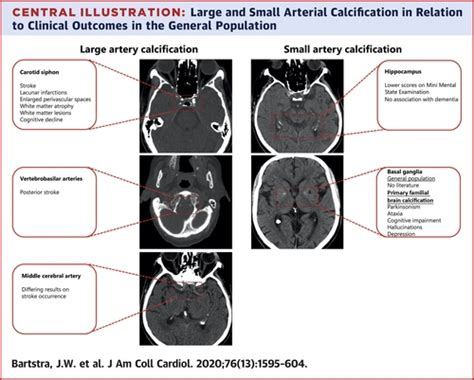 Intracranial Arterial Calcification Prevalence Risk Factors And