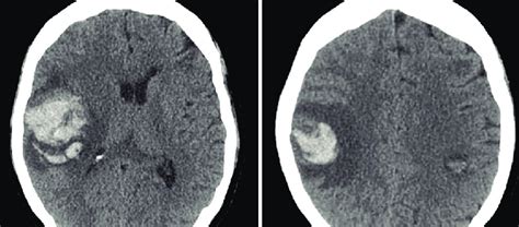 Axial Non Contrast Head Ct Upon Initial Presentation A Right Download Scientific Diagram