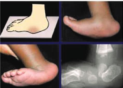 Congenital Vertical Talus Download Scientific Diagram