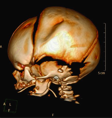 Three Dimensional CT Reconstruction Showing Invagination Of The