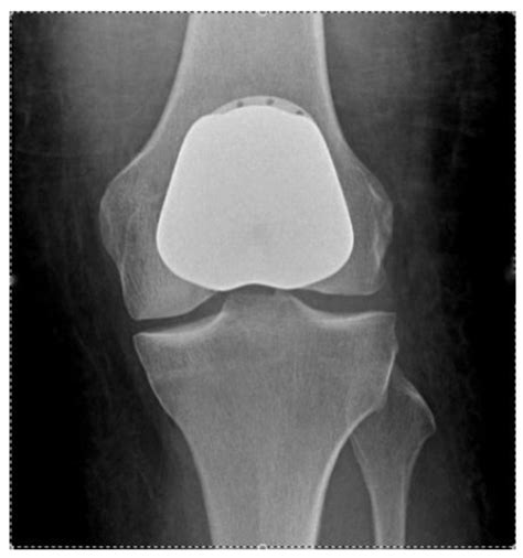 AP radiograph showing a Patellofemoral Arthroplasty. | Download ...